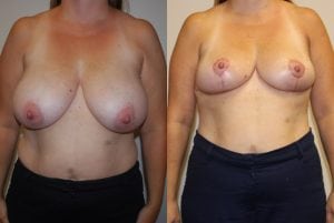 Before and After Image