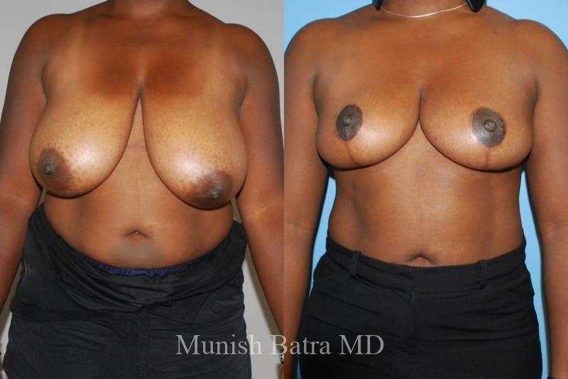Before and After Image