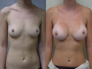 Before and After Image