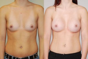 Before and After Image