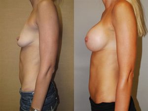 Before and After Image