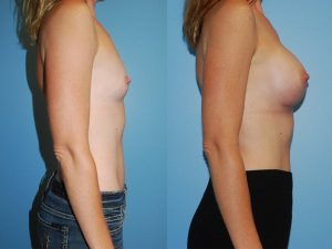 Before and After Image