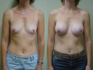 Before and After Image