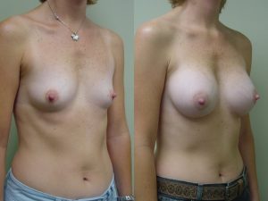 Before and After Image