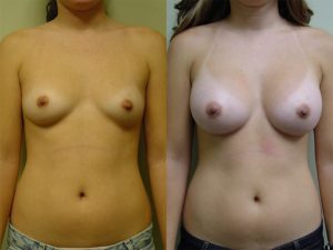 Before and After Image