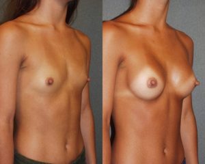 Before and After Image