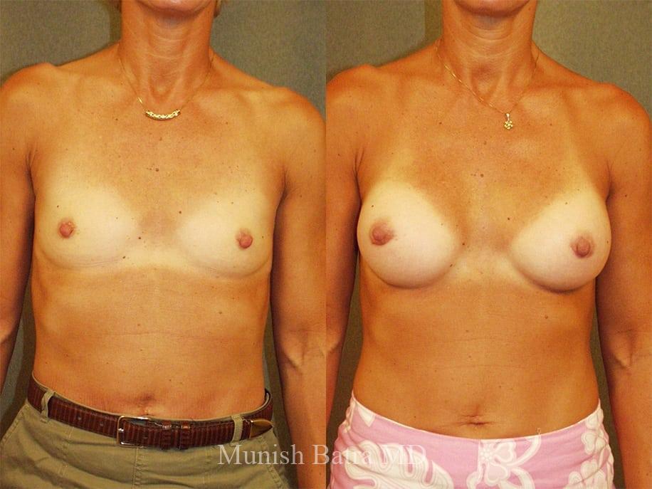 Before and After Image