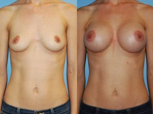 Before and After Image