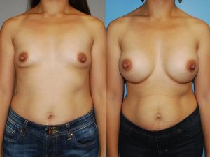 Before and After Image