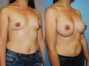 Before and After Image