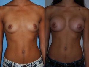 Before and After Image