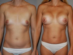 Before and After Image