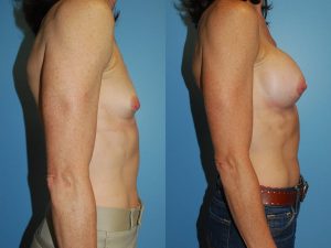 Before and After Image