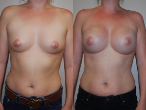 Before and After Image