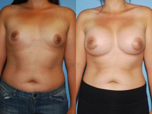 Before and After Image