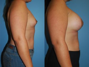 Before and After Image