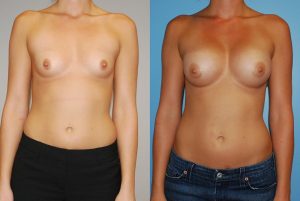 Before and After Image