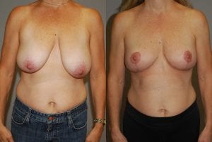 Before and After Image