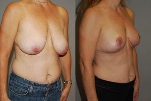 Before and After Image