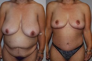 Before and After Image