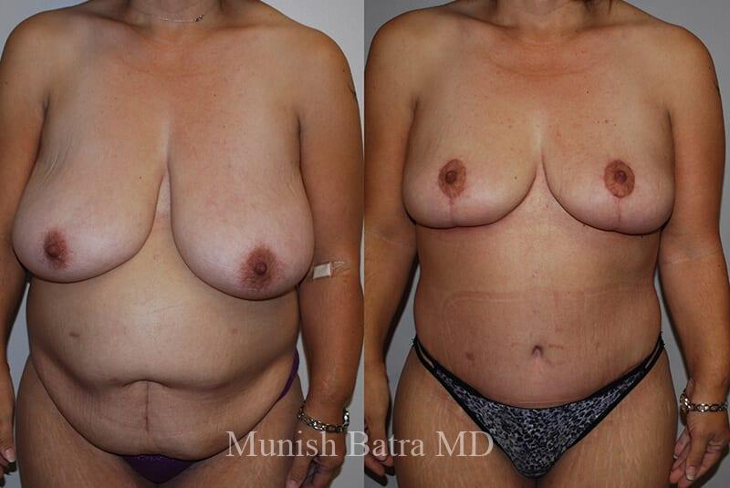 Before and After Image