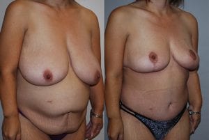 Before and After Image