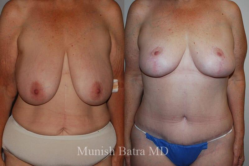 Before and After Image