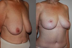 Before and After Image