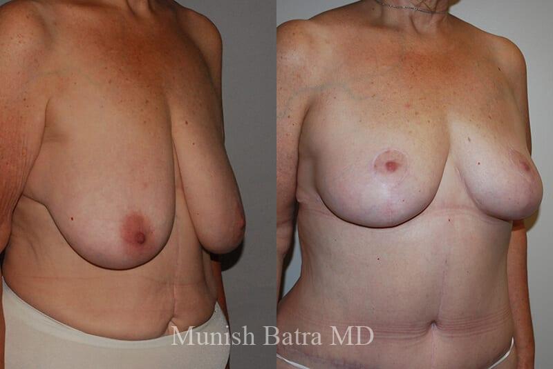Before and After Image