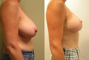 Before and After Image