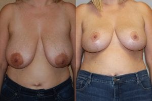 Before and After Image