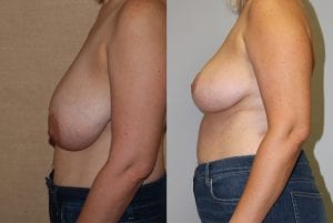 Before and After Image