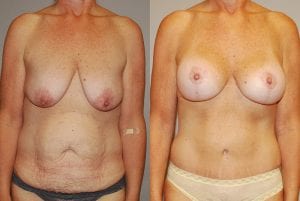 Before and After Image