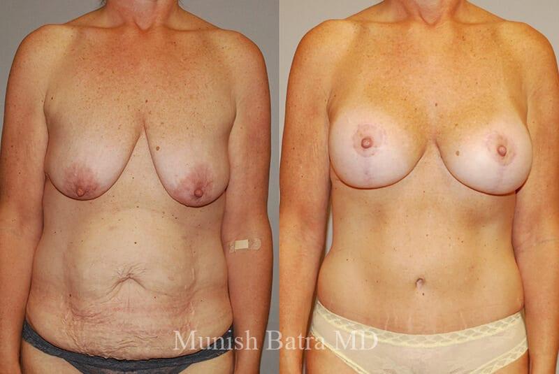 Before and After Image