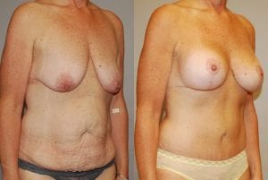 Before and After Image