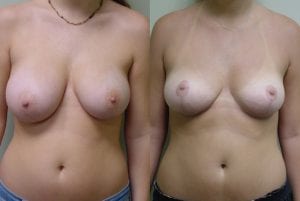 Before and After Image