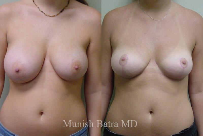 Before and After Image