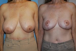 Before and After Image