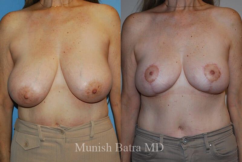 Before and After Image