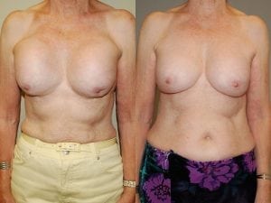 Before and After Image