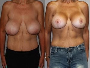 Before and After Image