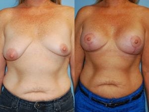 Before and After Image