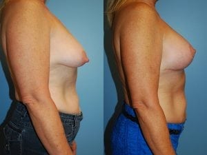 Before and After Image