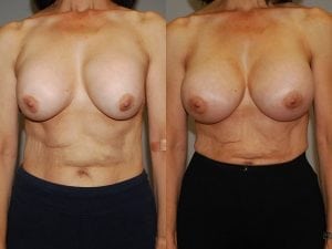 Before and After Image