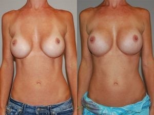 Before and After Image