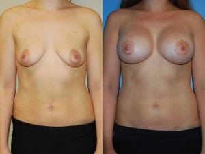 Before and After Image