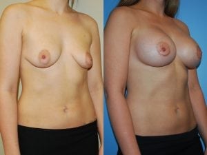 Before and After Image