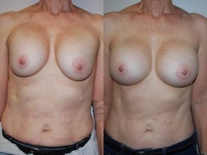 Before and After Image