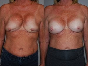 Before and After Image
