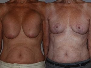Before and After Image